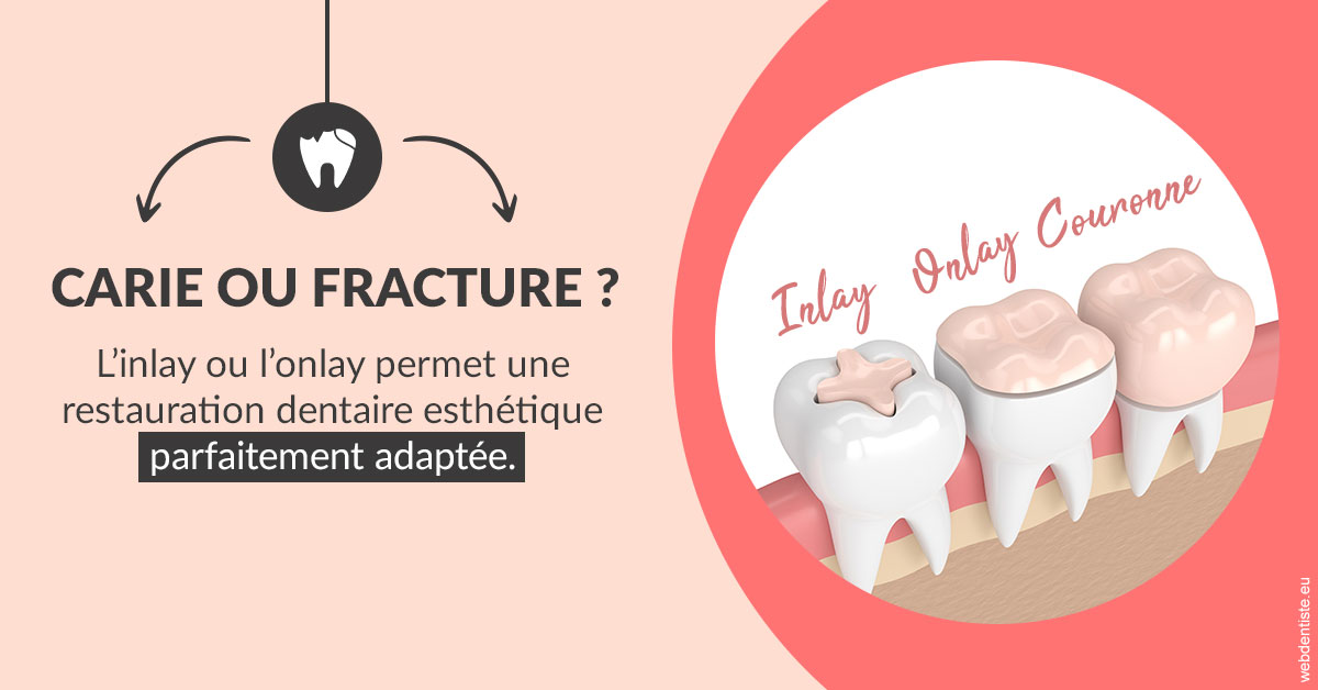https://dr-eric-dumolard.chirurgiens-dentistes.fr/T2 2023 - Carie ou fracture 2
