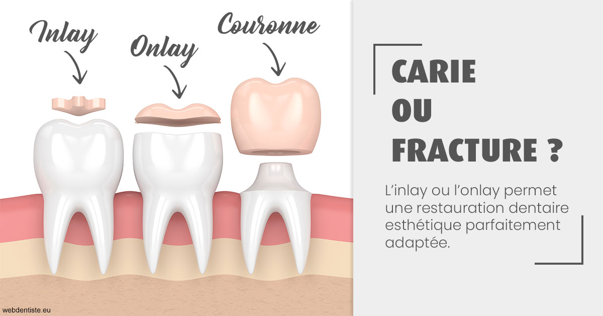 https://dr-eric-dumolard.chirurgiens-dentistes.fr/T2 2023 - Carie ou fracture 1
