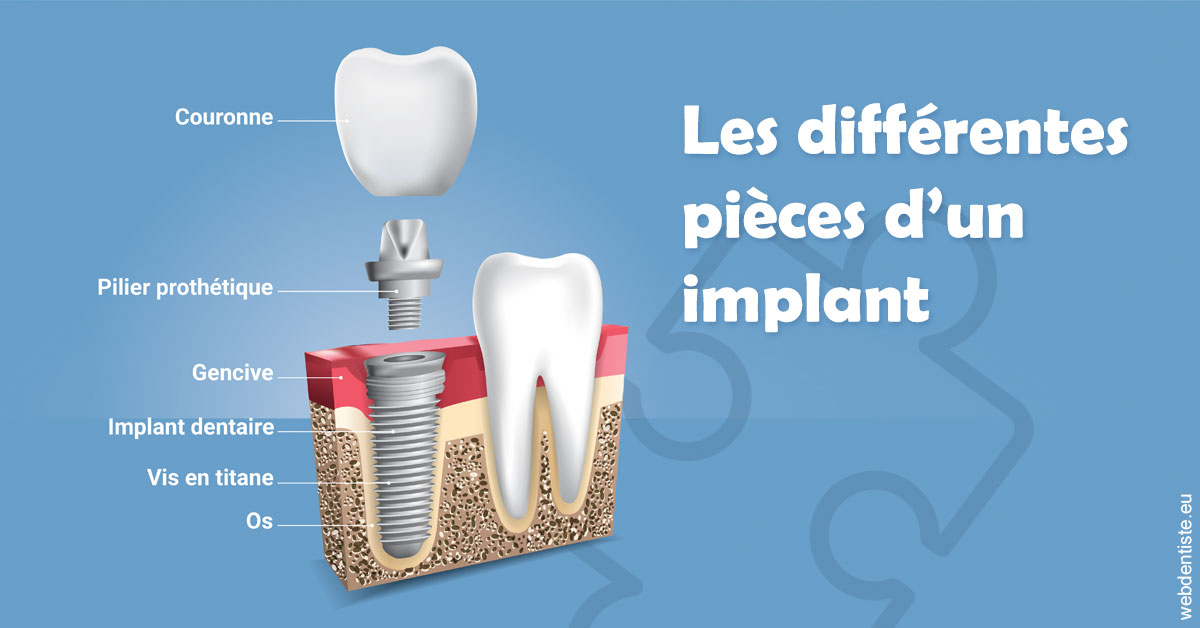 https://dr-eric-dumolard.chirurgiens-dentistes.fr/Les différentes pièces d’un implant 1